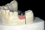 Figure 5  The prefabricated abutment on the working model with the soft-tissue simulation.