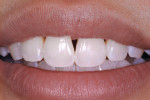 Figure 1 The patient was a young professional who sought treatment for her black triangles.
Close-up preoperative view. Rounded anatomy of crowns often equates to wider root
spacing, which in turn predispose an otherwise healthy dentition to black triangles.