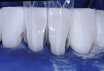 Figure 7 Mid-treatment view of lower arch
with Bioclear matrices in position. Because lower incisors are generally less rigid than
maxillary incisors, four matrices can be used at a time.