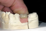 Figure 9  In the laboratory, the PFM crown was fitted to the custom abutment on the working model.