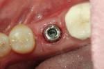 Figure 10  The prefabricated abutment inserted into the mouth.