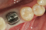 Figure 12  The custom abutment inserted into the mouth.