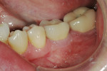 Figure 13  The PFM seated on custom abutment, 1 month after delivery.