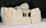 Figure 15  On the working model, the mushroom appearance of the crown and its prefabricated abutment can be seen.