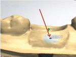 Annotating the location of the implant for the software to recognize.