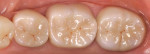 After cementation, the restorations were verified for proper fit and occlusion.