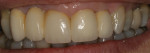 Frontal view after placement of a ceramic veneered lithium disilicate substructure.