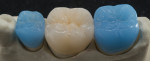 Milled wax units on model teeth Nos. 29 and 31. IPS e.max® CAD on model tooth No. 30.