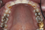 Figure 3 Upper arch before treatment.
