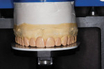 Figure 6 The diagnostic wax-up was done without preparing the teeth on the casts to visualize the additive nature of the restorations.