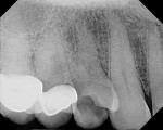 Figure 1 Pre-treatment digital periapical radiograph of site No. 5 confirming a vertical root fracture.