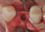 Figure 5 At surgical entry, site No. 5 showed complete destruction of the buccal wall and most of the buccal aspect of the palatal wall.