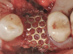 Figure 9 The ti-mesh was stabilized by two buccal and one palatal 3-mm screws, with 1 mm to 1.5 mm of space from proximal tooth surfaces.