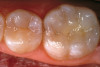 Fig 2. A preoperative retracted full-smile view. The restorations appear to be very “square” and “bulky.” The incisal embrasures are small, helping to make the teeth look uniform and square.