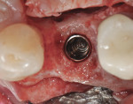 Figure 19 Final implant in-situ; 3 mm of bone was measured buccal to the implant.