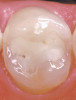Fig 6. This oblique view shows the original facial position of the maxillary left central incisor. This position would dictate the final positions of the adjacent teeth, which would need to be thicker in the facial direction to make up for their lingualized preoperative location.