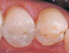 Fig 7. One-mm-depth cuts are placed in the incisal edge of the maxillary right central incisor to make space for porcelain in the new restorations maintaining a 10-mm cervico-incisal length.