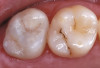Fig 11. The maxillary provisional restoration is shown in this retracted intraoral full-arch view.