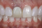Figure 5 Preoperative
view of patient with gingival darkening with metallic post.