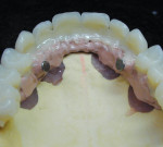 The veneers are bonded to the metal overcasting with Combo.lign.