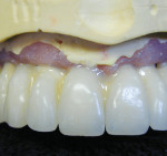Crea.lign is applied to the interproximal spaces.