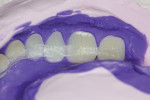 eFiber is Translucent, flexible, and easy to adapt to individual tooth anatomy.