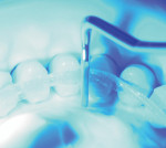 eFiber is bonded individually to each tooth.