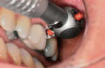 Figure 9  The reciprocating handpiece with a safe-sided flat tip has access to safely recontour gingival overhang.