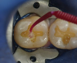 Figure 4. Some systems rely on the application of a very weak acid within the bonding liquid to provide for the mechanical and chemical retention of the bonding agent to the tooth.