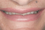 Figure 4 Full smile with minimal display of teeth.