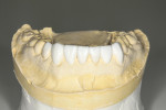 Figure 6 Mandibular diagnostic wax-up.