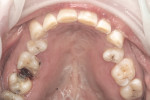 Figure 9 Occlusal view of the maxillary dentition, demonstrating no preparation on the majority of teeth and the removal of old restorations.