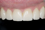Figure 13 Completed restorations on maxillary
teeth.
