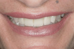 Figure 15 Smile view of completed restorations.
