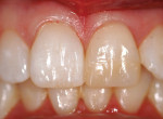 Figure 1. Pre-operative view of the patient’s dentition showing tooth No.9 slightly dehydrated.
