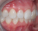 Figure 3. Right lateral view of the patient’s dentition.