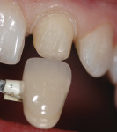 Figure 6. Shades were compared and contrasted
with the prepared tooth.