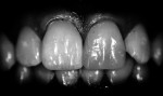 Figure 9. Lightroom effect, high contrast view to
expose all the characteristics of tooth No.8.