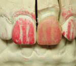 Figure 12. The complete diagnostic wax-up.