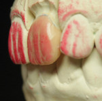 Figure 13. The left lateral view of the wax-up was evaluated to determine correct reflective and deflective zones.