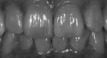 Figure 22. Black and white evaluation with darkened contrast of the all-ceramic restoration during try-in.
