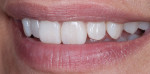 Figure 20. Left lateral image of the restoration tried in patient’s mouth, natural smile view.