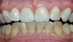 Figure 2  Crest® Whitestrips® used for tetracyclinestained teeth. The lower arch was used as a control.
