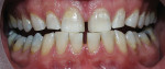 Figure 3b  Both arches immediately posttreatment using a light-activated whitening system.