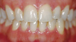 Figure 4a  Pretreatment view using an OTC, light-activated tooth whitening system.