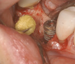 Figure 6 Tetracycline paste is used to debride the implant surface.