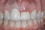 Figure 1 View of the patient’s preoperative dentition in situ.