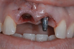 Tooth No. 8 was extracted and the implant was placed.