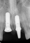 Figure 6 Radiograph following and confirming
implant placement.