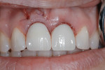 Figure 7 Image depicts the view of the new provisional restorations for
teeth No. 8 and No. 9.